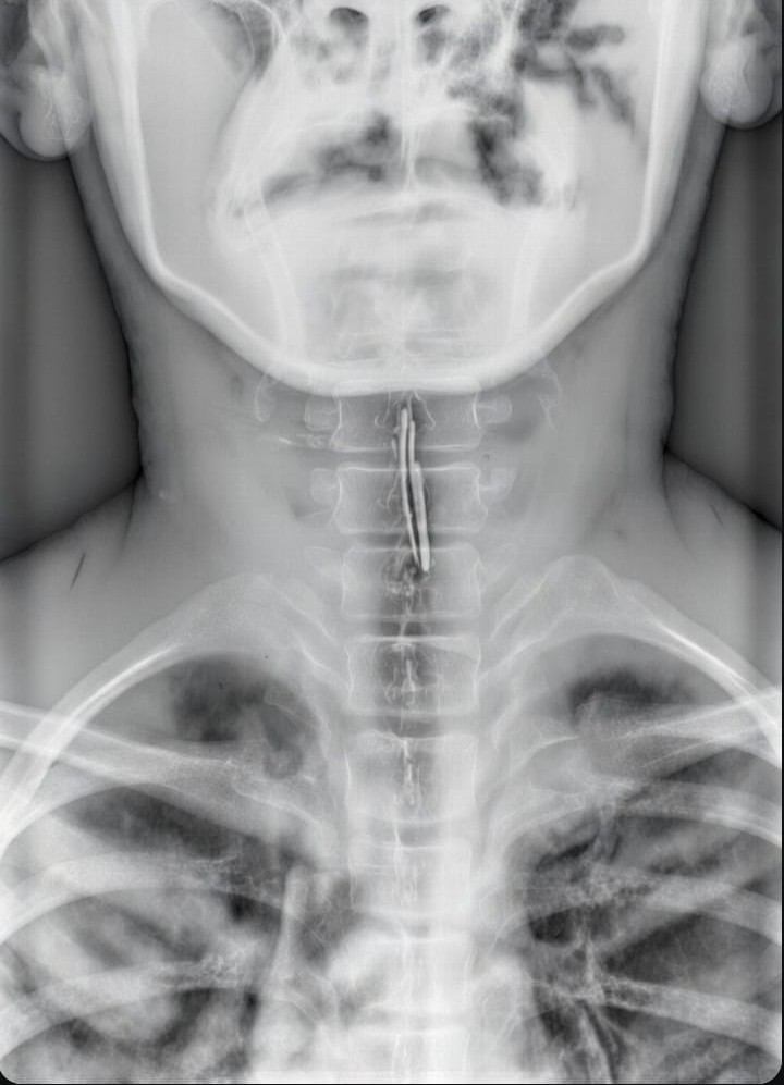 Thorn in the Throat | Betrayed Promise | Depression | God’s Saving | Single Connected Experience