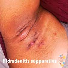 Hidradenitis: What it is?