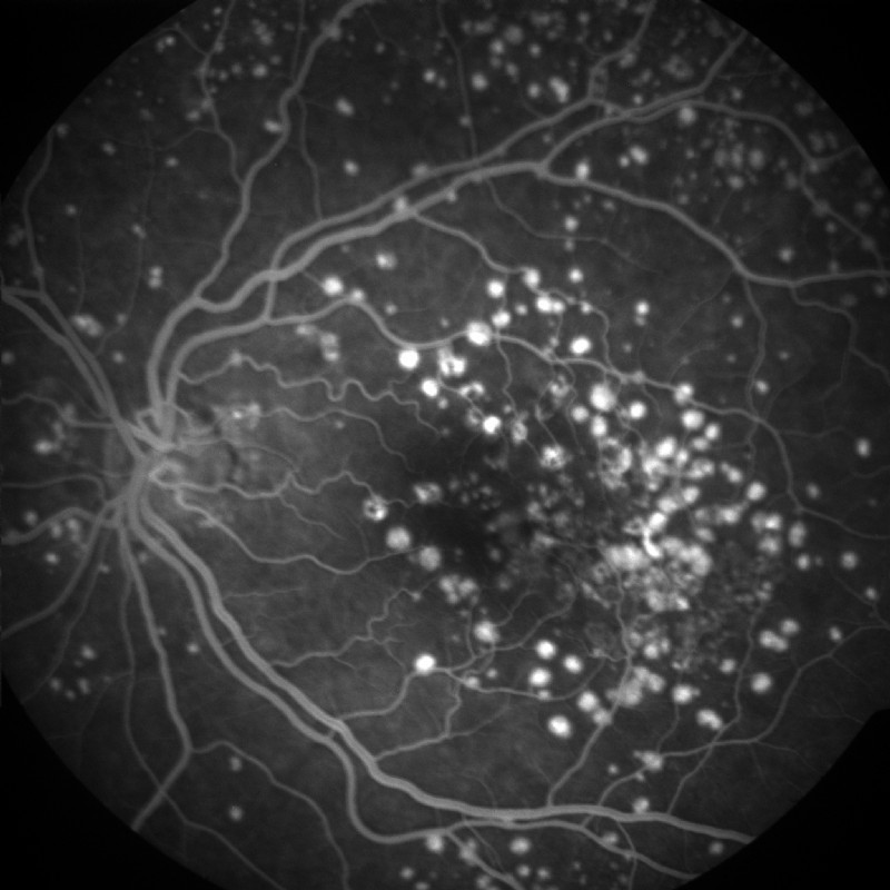 AN ATYPICALLY DISTRIBUTED FLECK CASE WITH MULTIPLE RETINAL PIGMENT EPITHELIAL DETACHMENTS