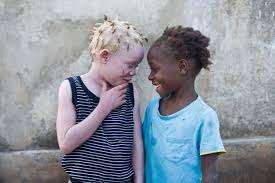 Understanding Albinism