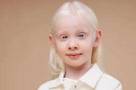 Albinism