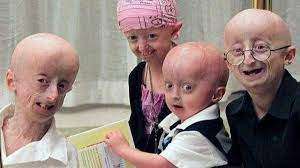 Progeria